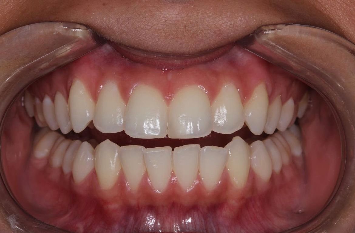 blanqueamiento dental cali (2)