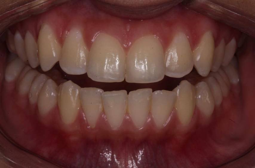 blanqueamiento dental cali