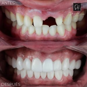 6-resultados-daniel-rivera-odontologia-cali--
